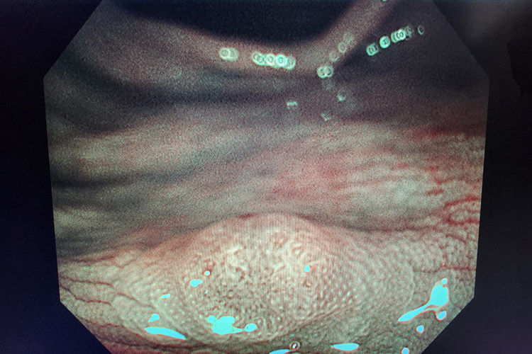 大腸ポリープのイメージ画像