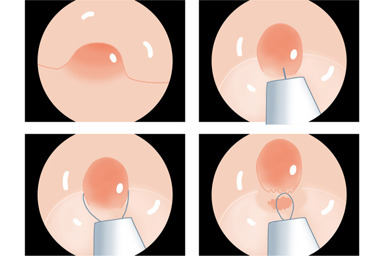大腸ポリープの切除イメージイラスト