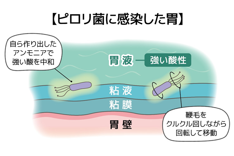 ピロリ菌に感染した胃のイメージイラスト